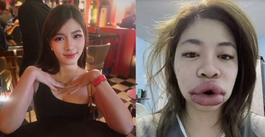 태국의 한 여성이 입술 성형을 위한 필러 시술 후 심각한 알레르기 부작용 사진을 공개해 충격을 주고 있다.<키티야 메나루지 페이스북 캡처, 바스틸레포스트 보도 캡처>